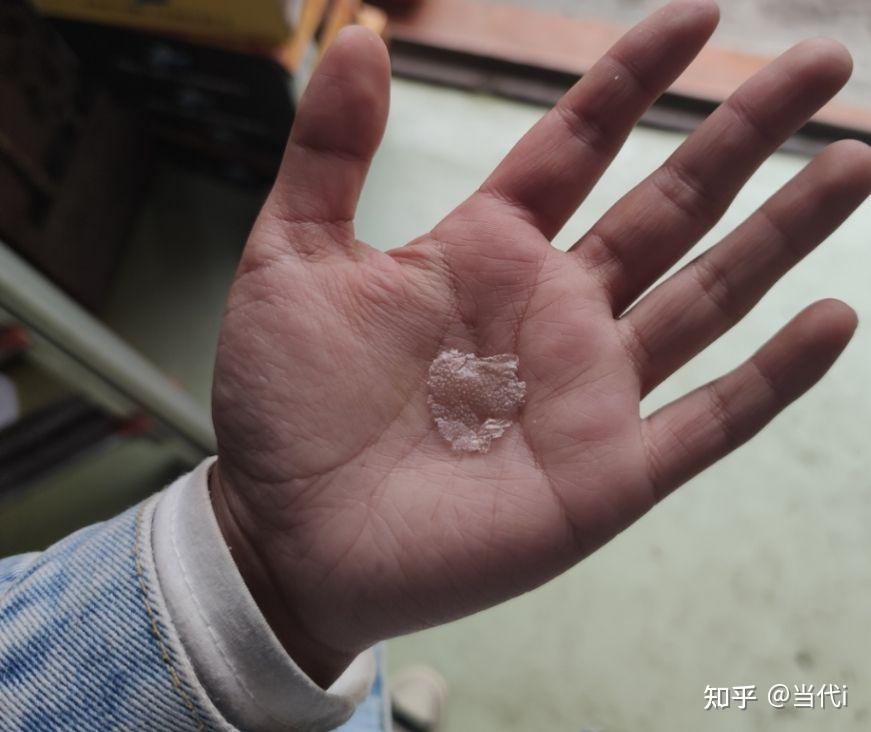 见过的最大头皮屑多大?