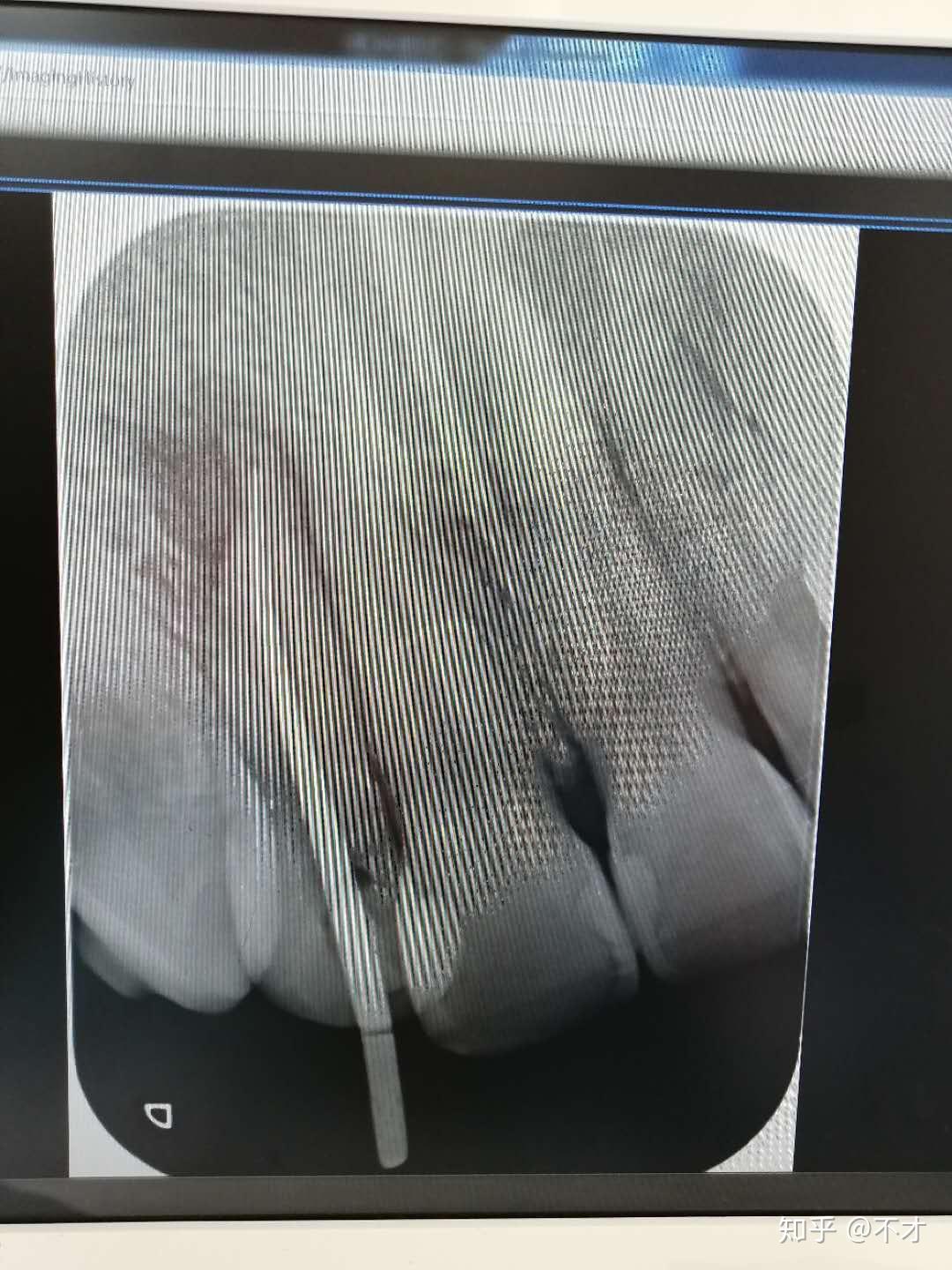 根管治疗有可能出现断针情况 另附补门牙经验分享