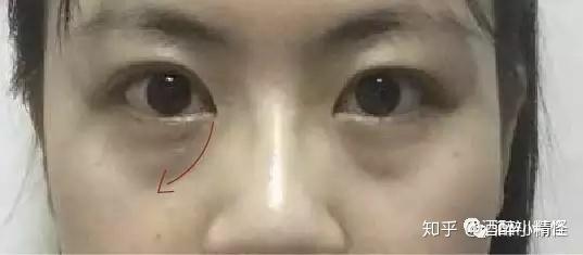 怎么样才可以去眼袋泪沟 v2-204b82b43603971603427a00ec49a67c_r.jpg