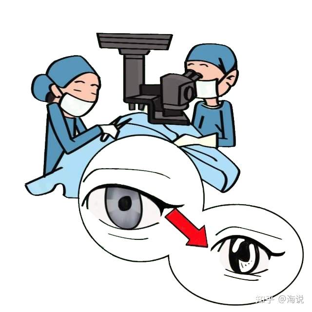 现代眼科显微手术技术迅速发展,先进医疗器械不断更新,目前白内障手术