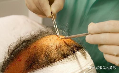 关于种植发际线的十个常见问题