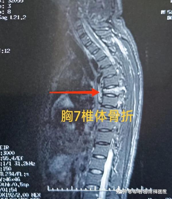 高难度胸7爆裂压缩骨折 微创经皮椎弓根螺钉复位固定术 - 知乎
