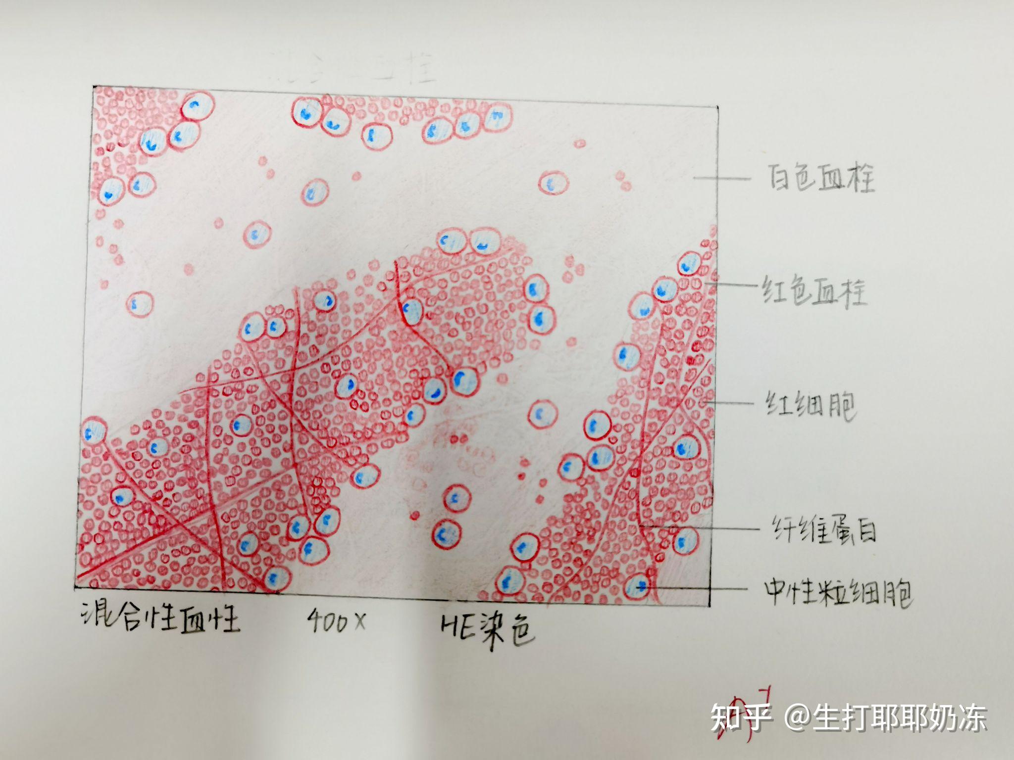 混合血栓红蓝手绘图图片