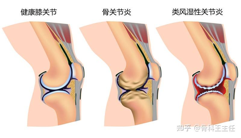 膝盖骨结构彩色示意图图片