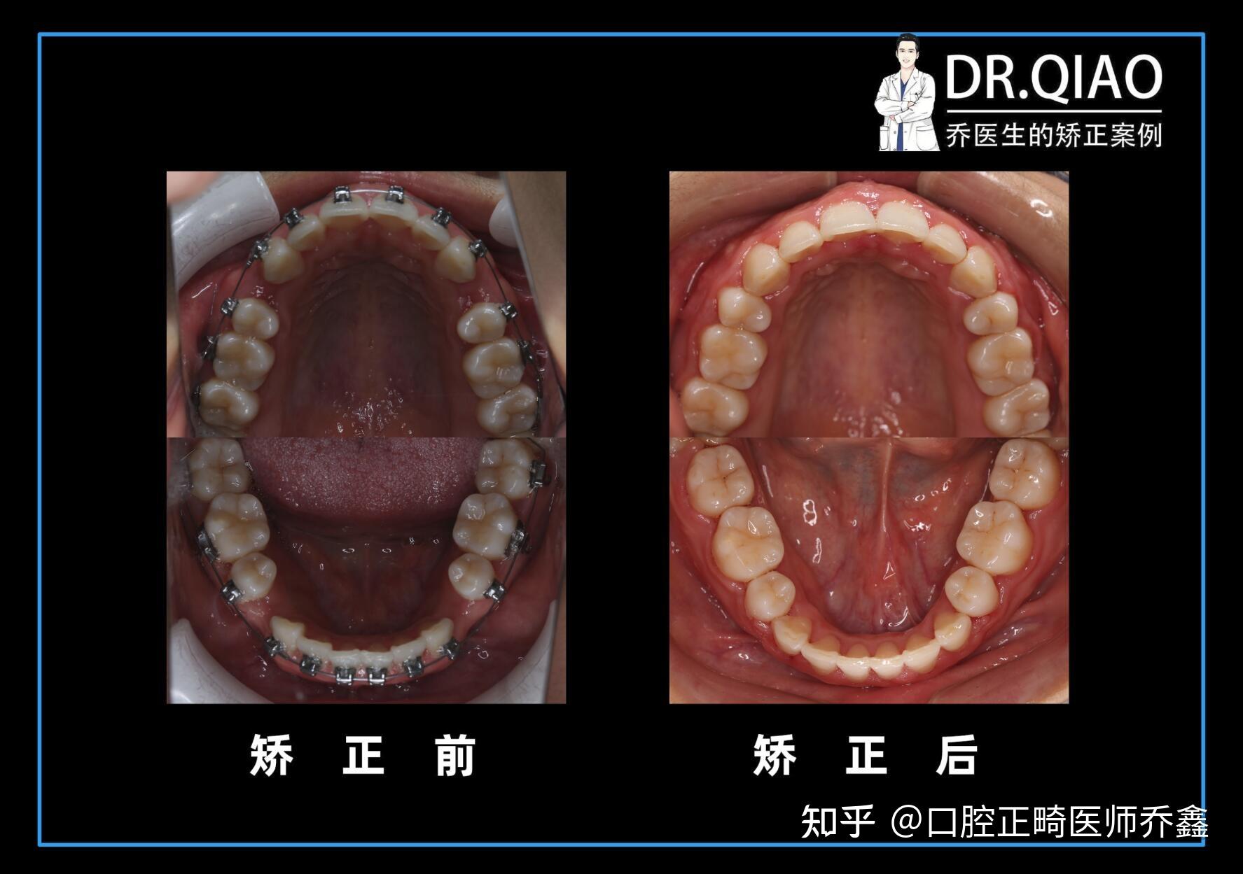 牙齿内倾型深覆合用不用矫正