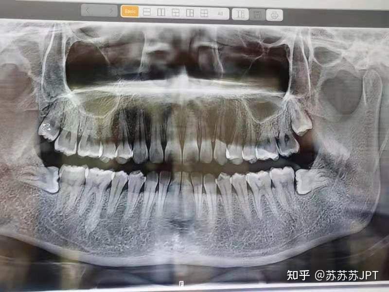 横着长的智齿不疼一定要拔