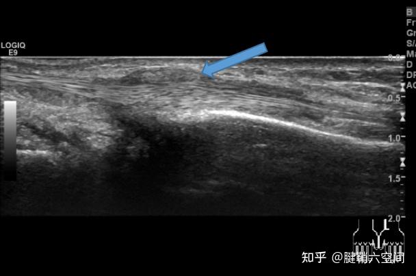 骨化性肌炎超声图片图片