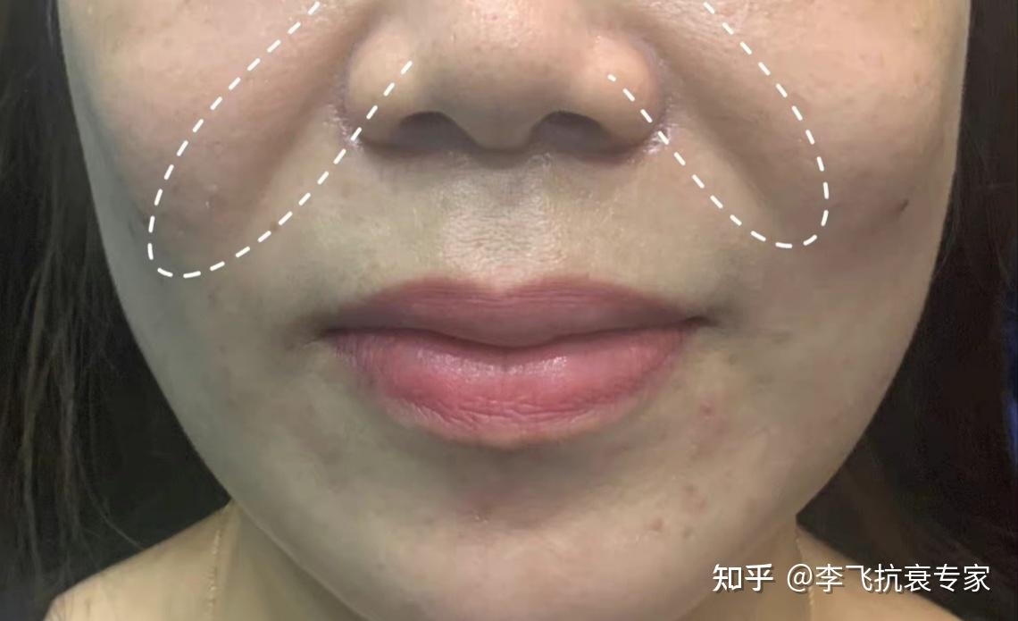 #李飞抗衰老#关于鼻唇沟你能了解多少呢? - 知乎