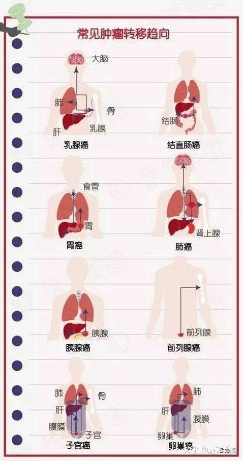 会 行走 的肿瘤 肿瘤容易转移哪些部位 每个人应该知道 知乎