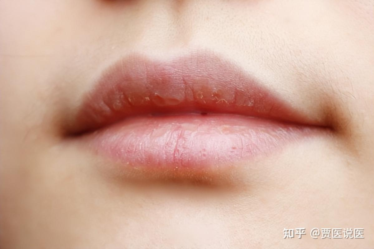 嘴唇干裂是什么原因引起的，是缺水吗？_症状_现象_嘴角