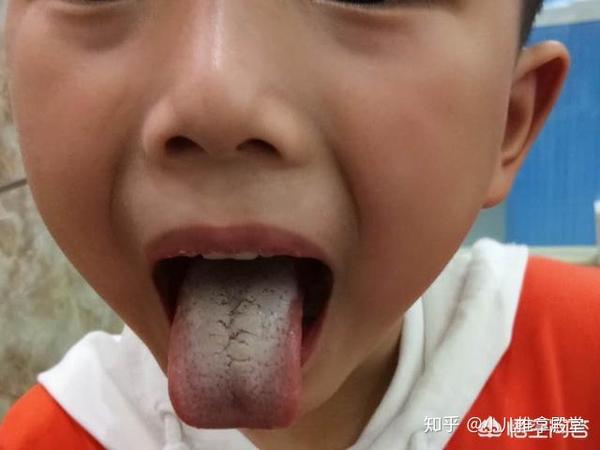 宝宝口臭是什么原因 了解背后的真相 妈妈不敢再放任孩子了 知乎