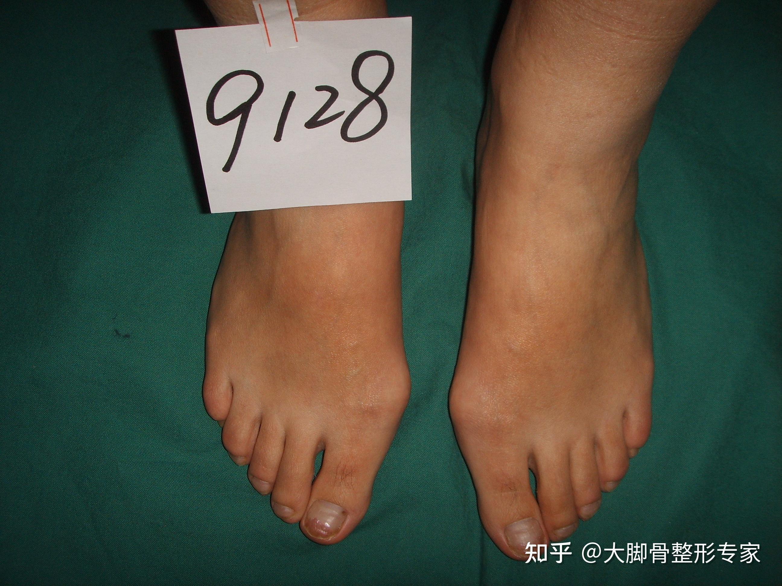 新疆乌鲁木齐大脚骨手术矫正案例 | 拇外翻|湖南长沙拇外翻手术|从2004年起专业矫正大脚骨