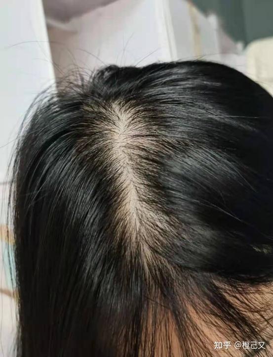 请问女生经常掉头发,会不会把头发掉光了?