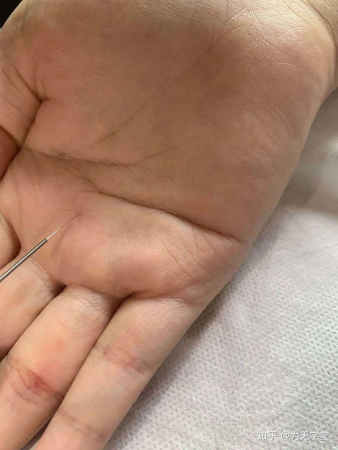 中风分型及手针治疗