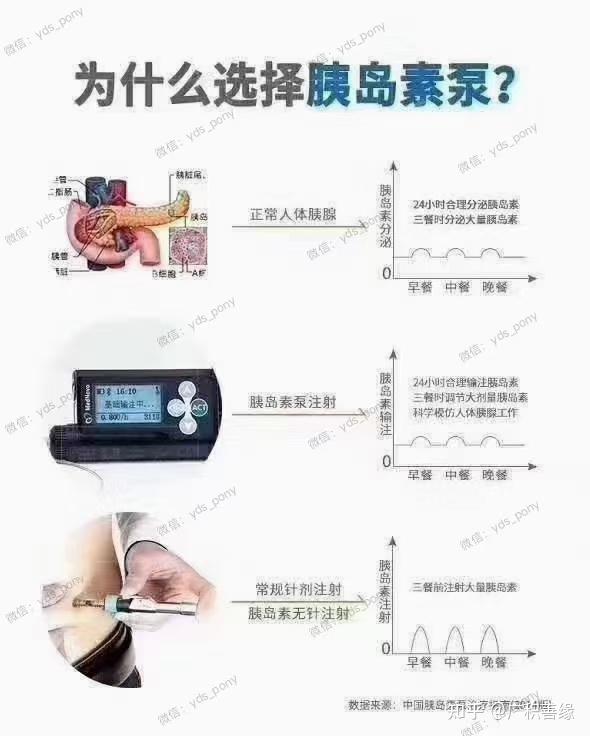 什么是胰岛素泵治疗?为什么戴泵优于打针?