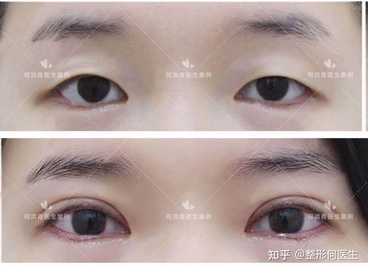 刘亦菲的开扇型双眼皮依然很受欢迎！ 目前双眼皮形状_圈子-新氧美容整形