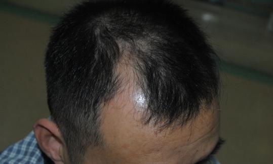 男性脱发怎么治疗才最有效