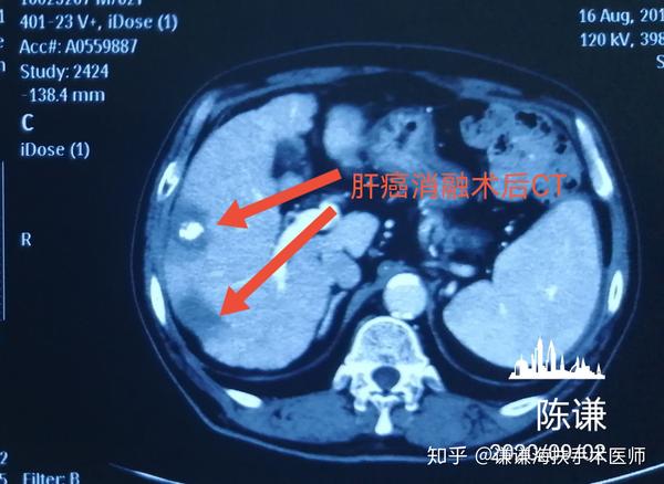 肝癌消融為什麼要做介入治療