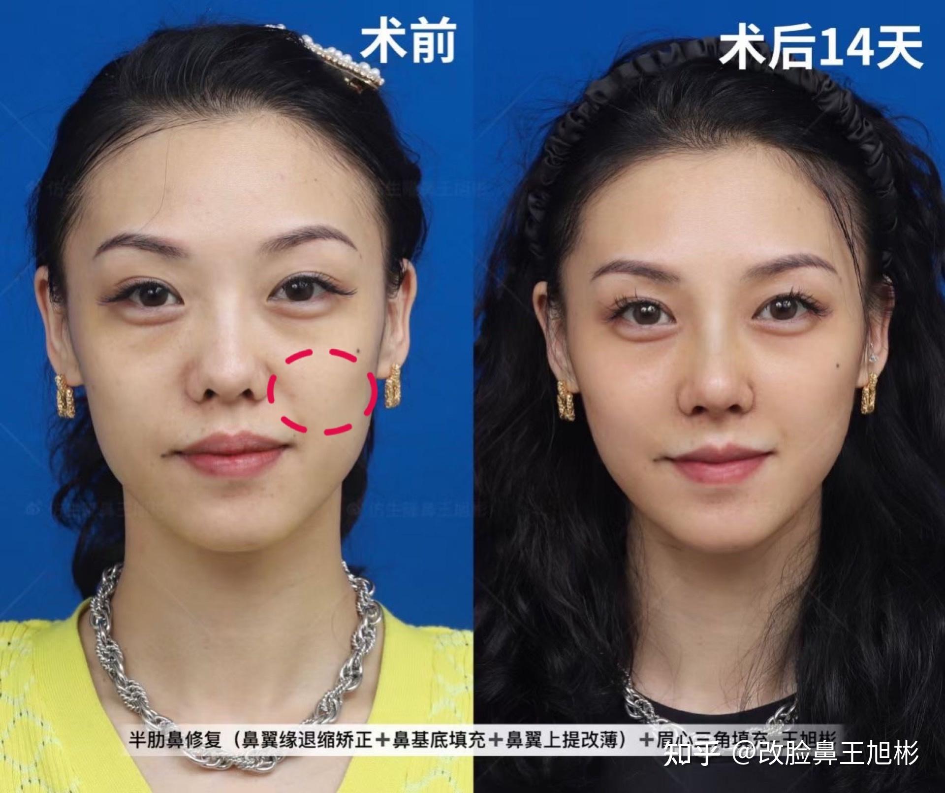 如何判断鼻基底是否凹陷学会这两招就够了隆鼻整形科普