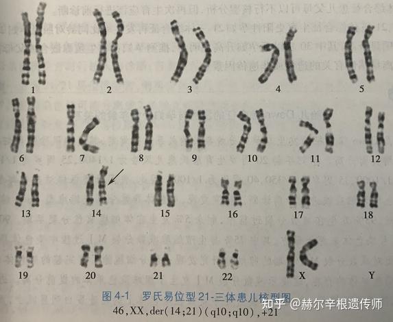 21三体综合征 染色体图片