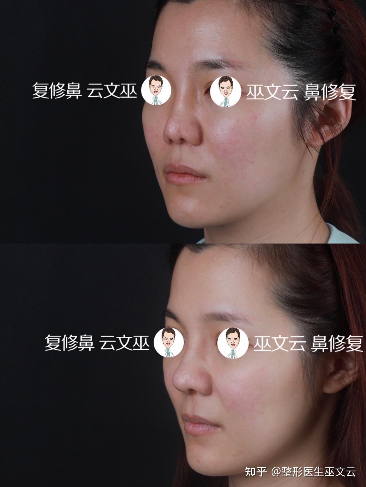巫文云挛缩鼻修复集锦技术和审美都很重要