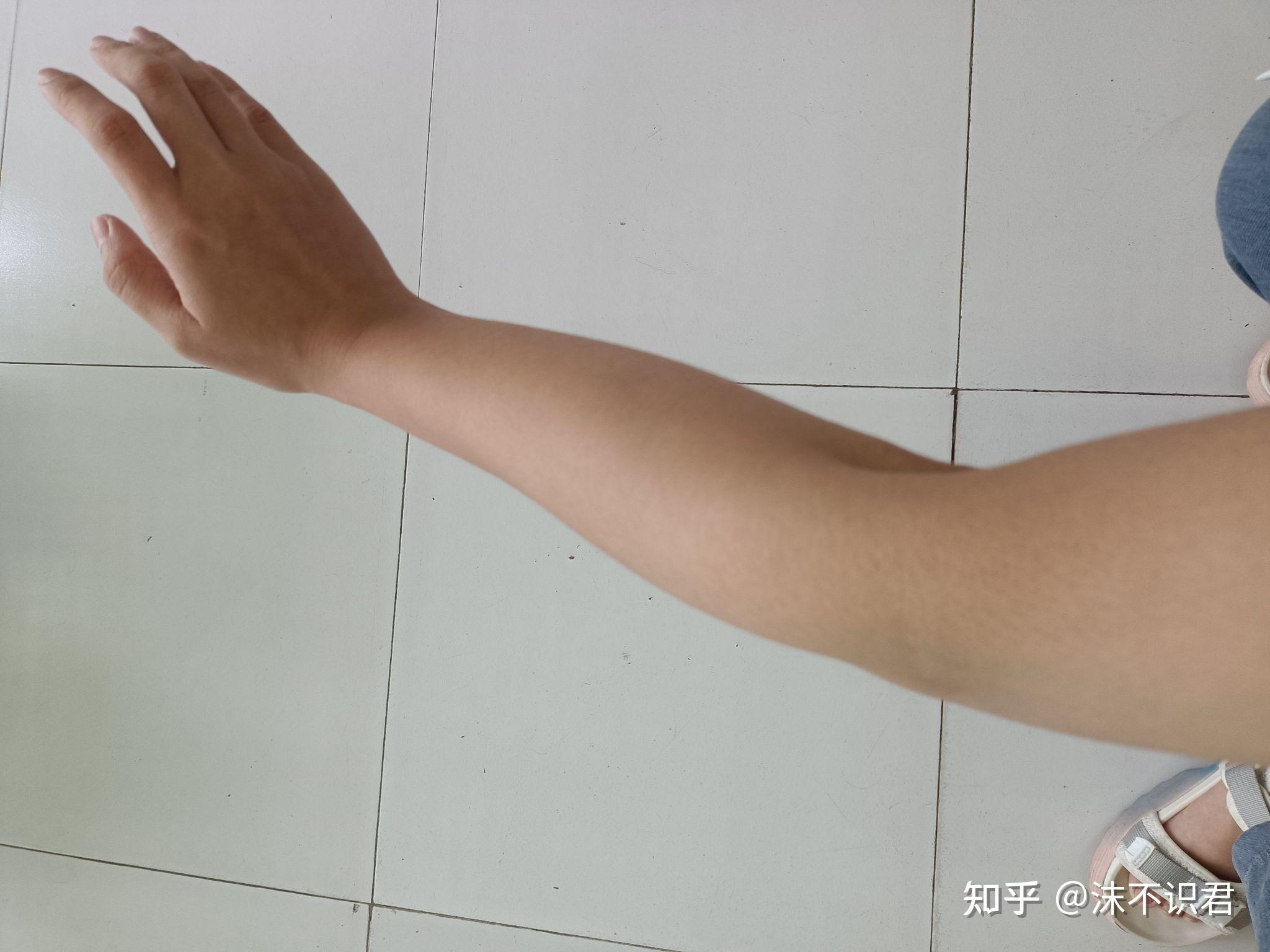 肘关节过伸如何矫正?