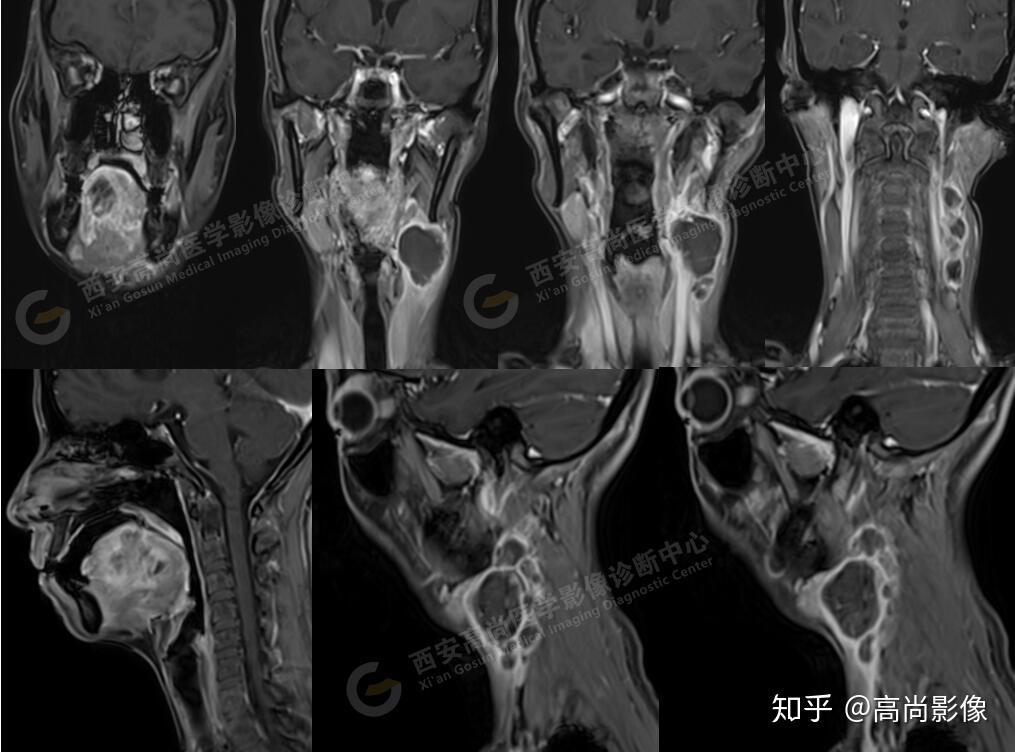 【西安高尚医学影像诊断中心病例】口腔鳞状细胞癌2例 - 知乎