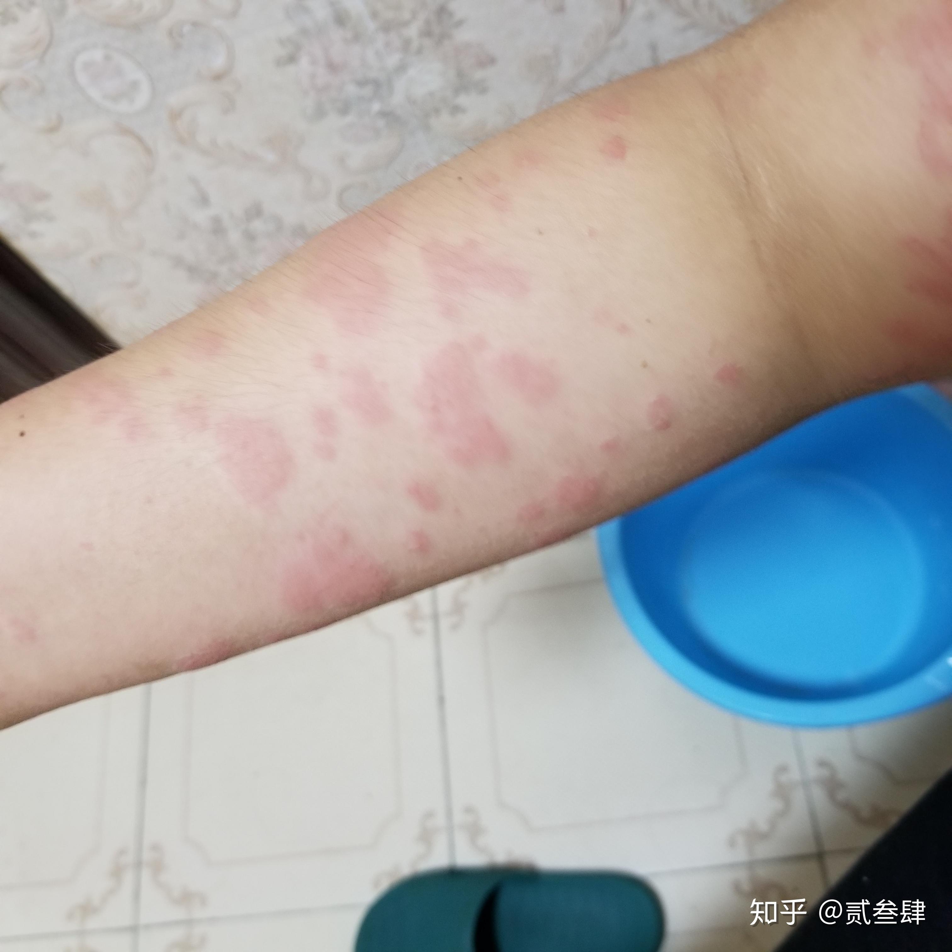 得了荨麻疹是什么体验