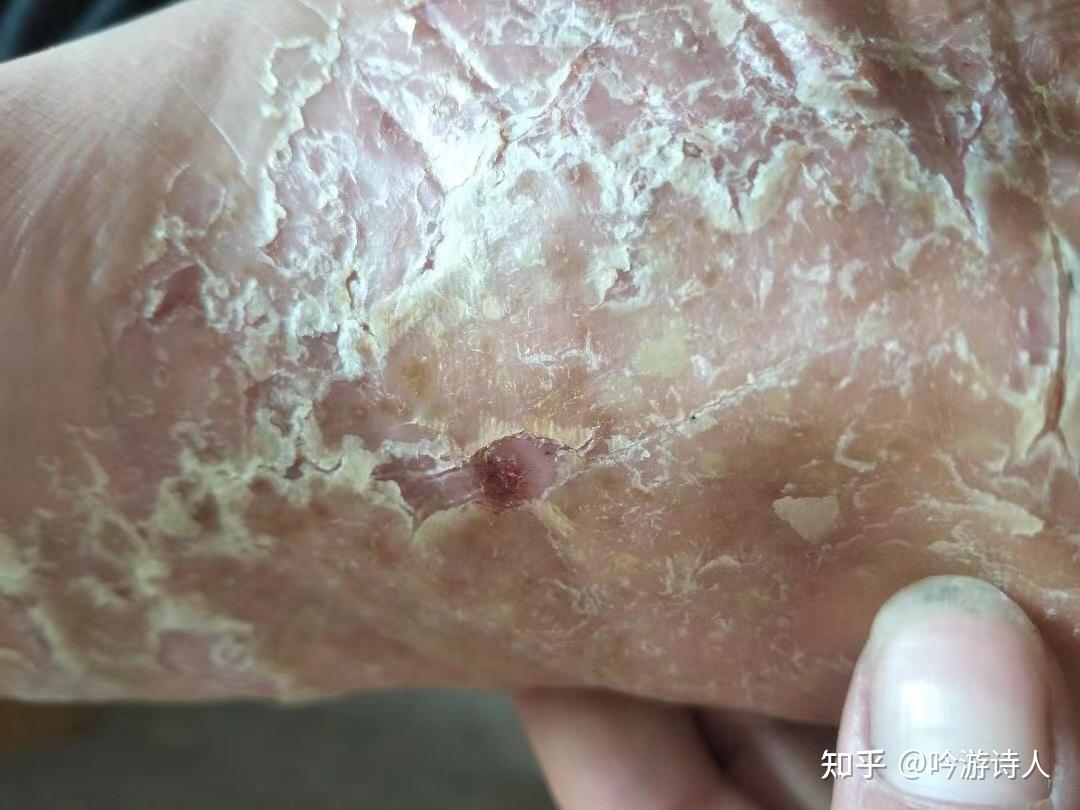 水泡型脚气,是在太痒,抓破了怎么办? - 知乎