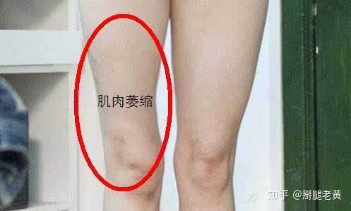 跟腱断裂手术后总感觉跟腱变短了怎样康复锻炼能把跟腱拉长
