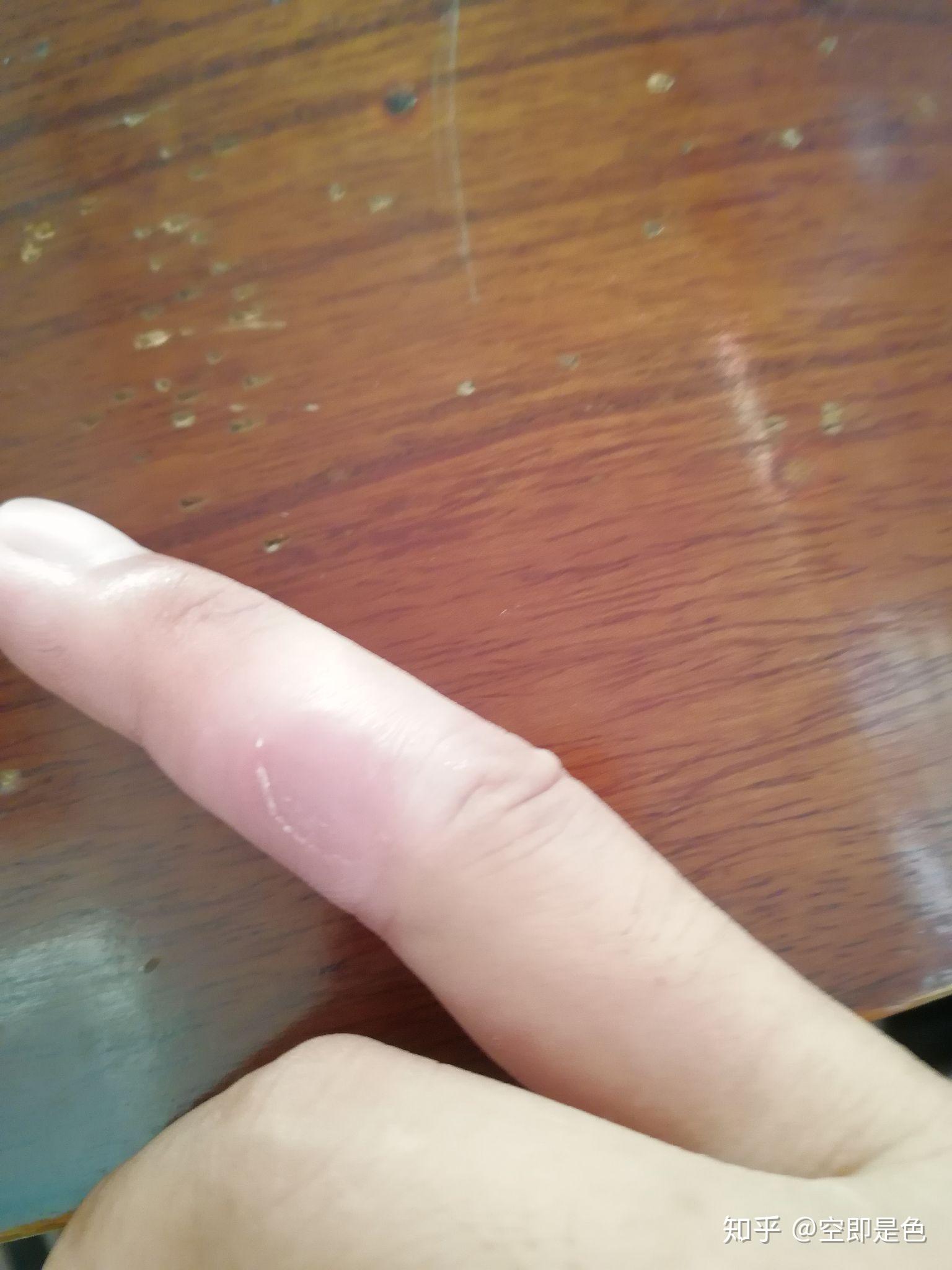 鸡眼到底有没有根刺? - 知乎