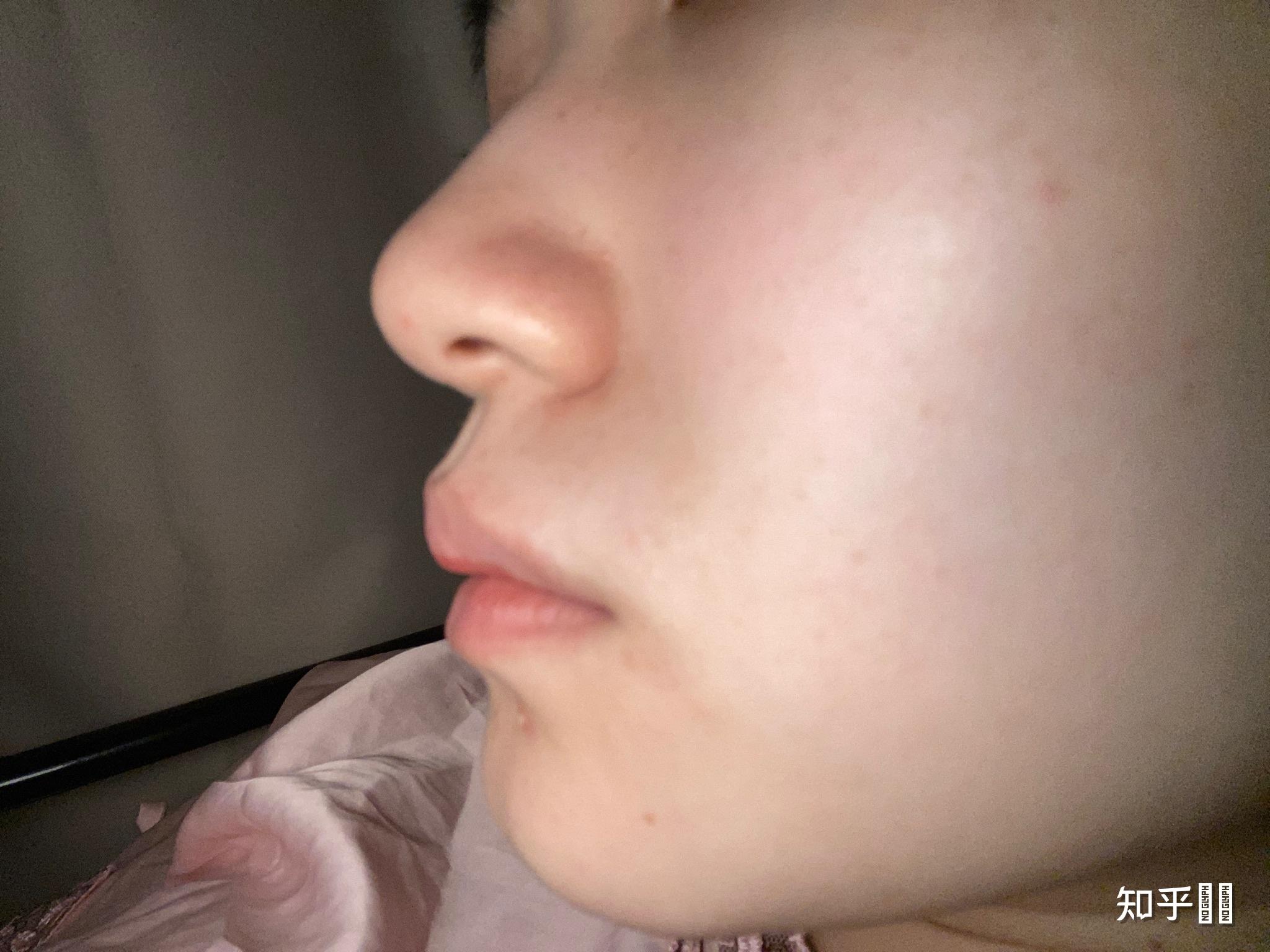 我到底是凸嘴还是人中肉厚? - 知乎