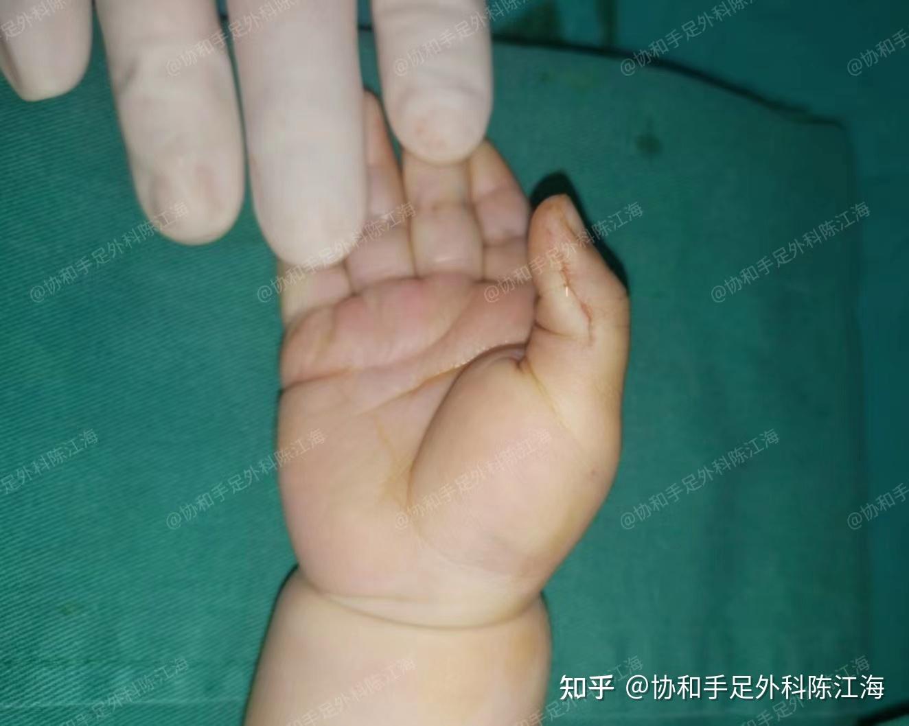 六指割掉后能入伍吗? - 知乎
