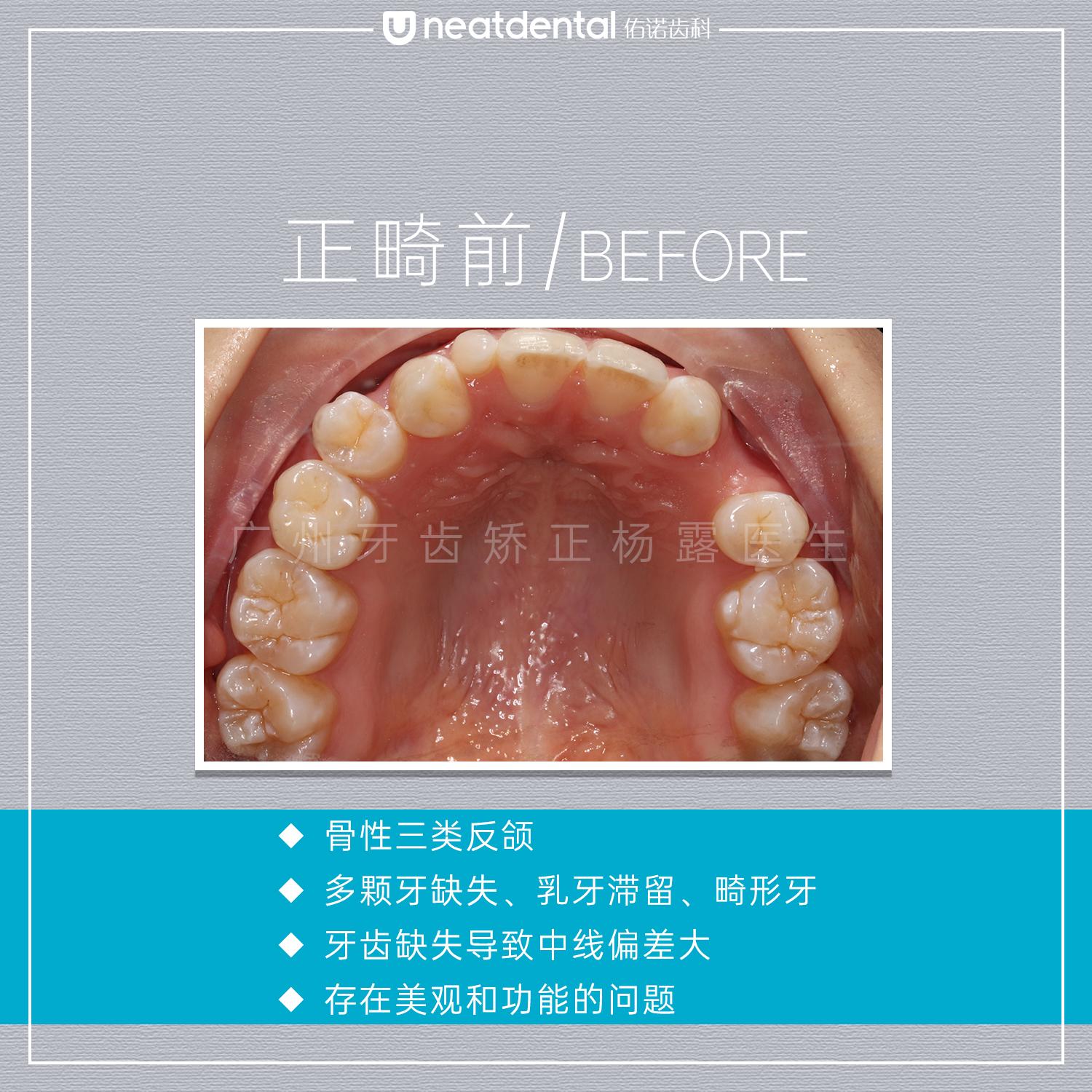 上颌多颗牙连续缺失种植体支持螺丝固位的固定式修复1例——从PICK-UP技术即刻负重到CAD/CAM一段式固定桥修复-口腔科学-医学