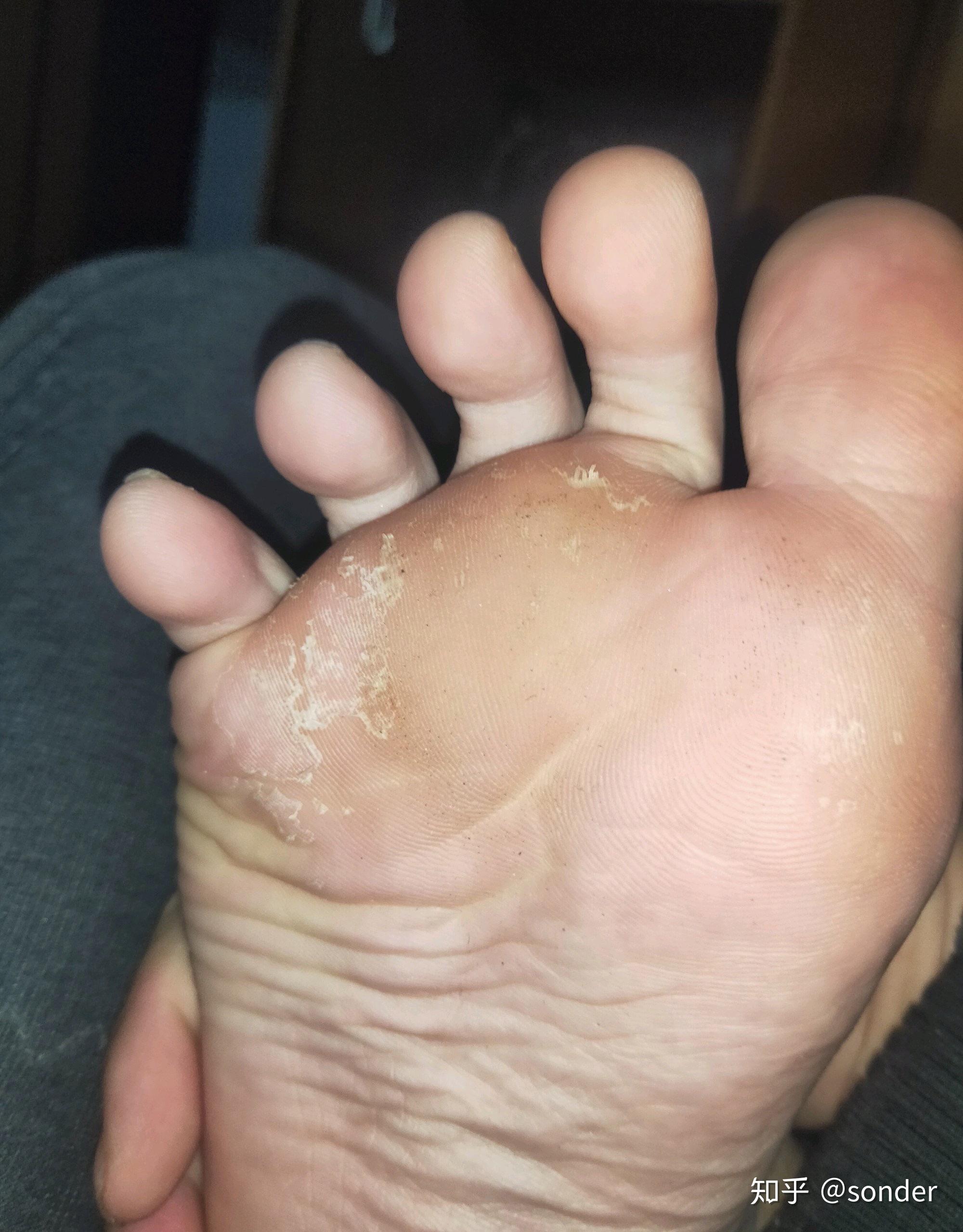 你们的脚气是怎么治疗好的