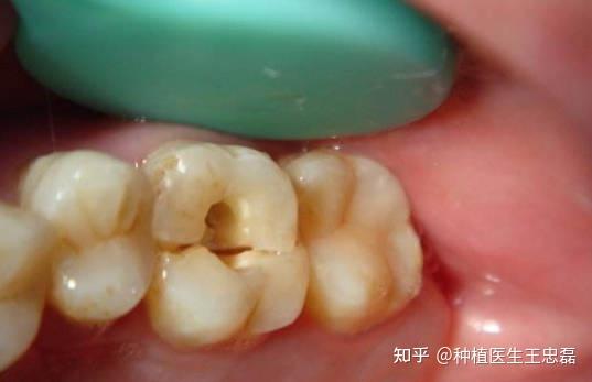 做了根管治疗的牙还疼,牙科医生:警惕这三种原因! - 知乎