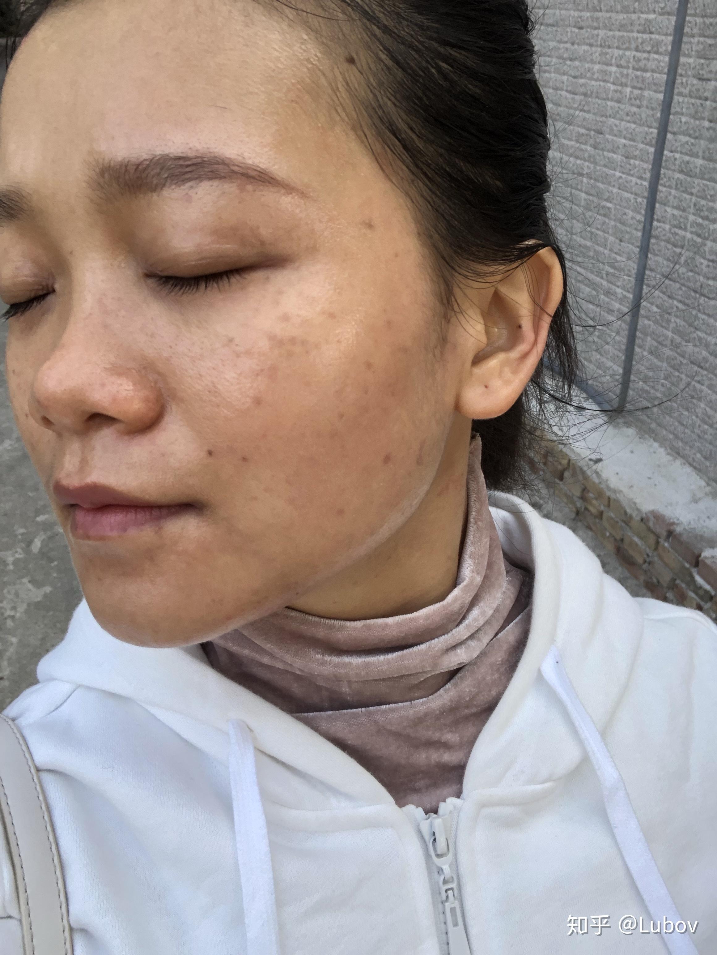 祛斑提取后美容院说要用他家产品一年感觉要吃土了