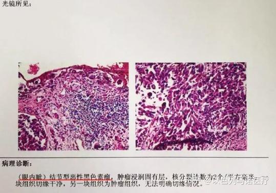 教你看懂自己的黑色素瘤病理报告