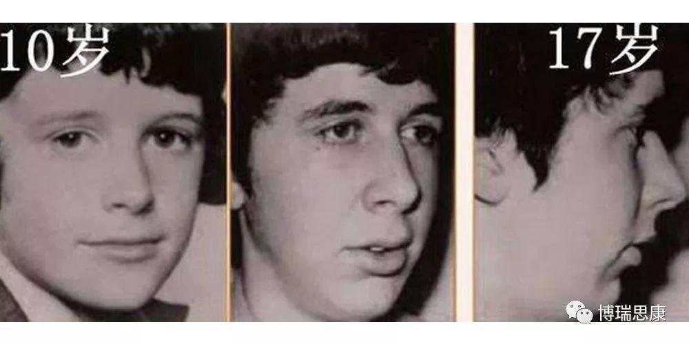 儿童鼻炎会导致越长越丑吗