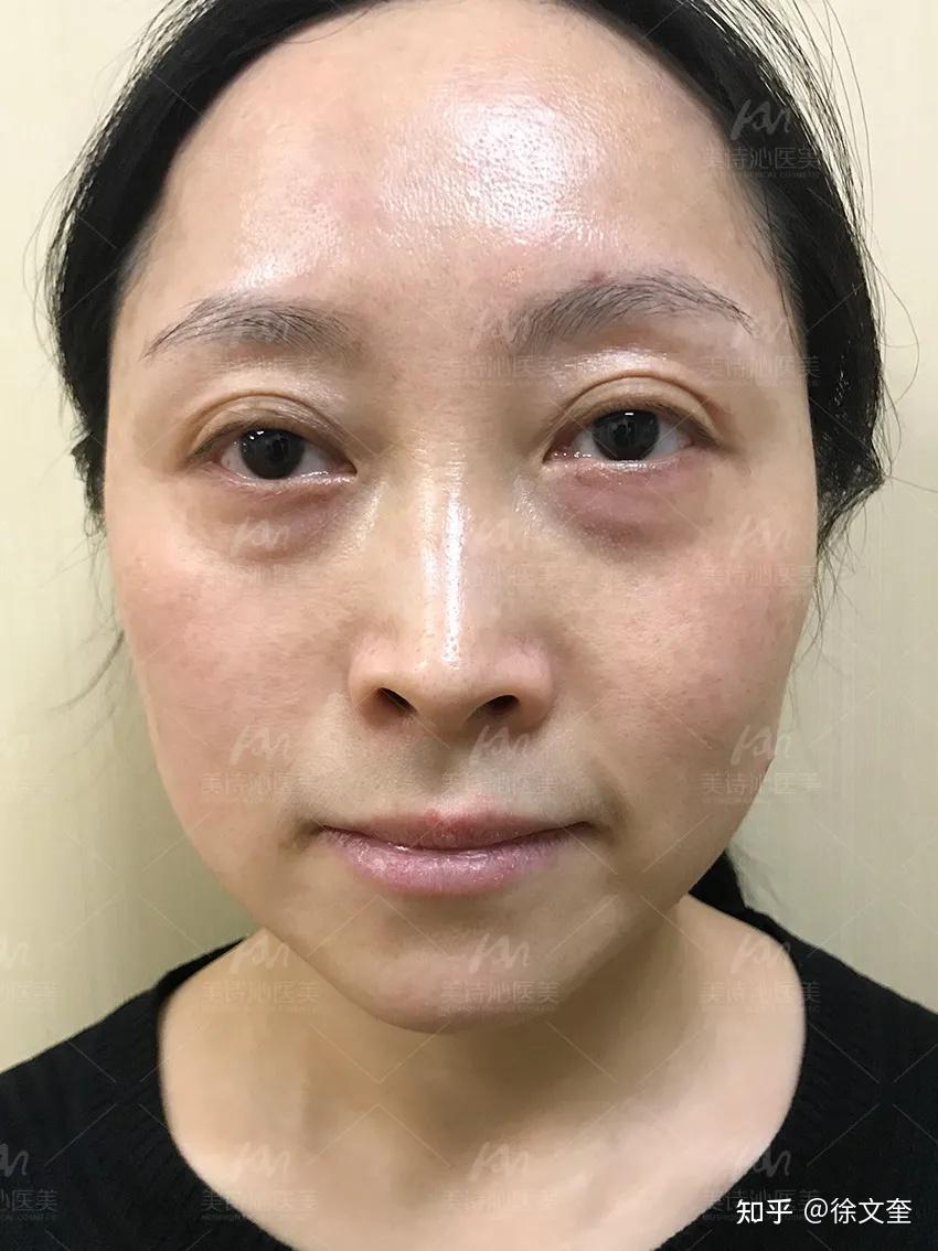 眼部老化更严重