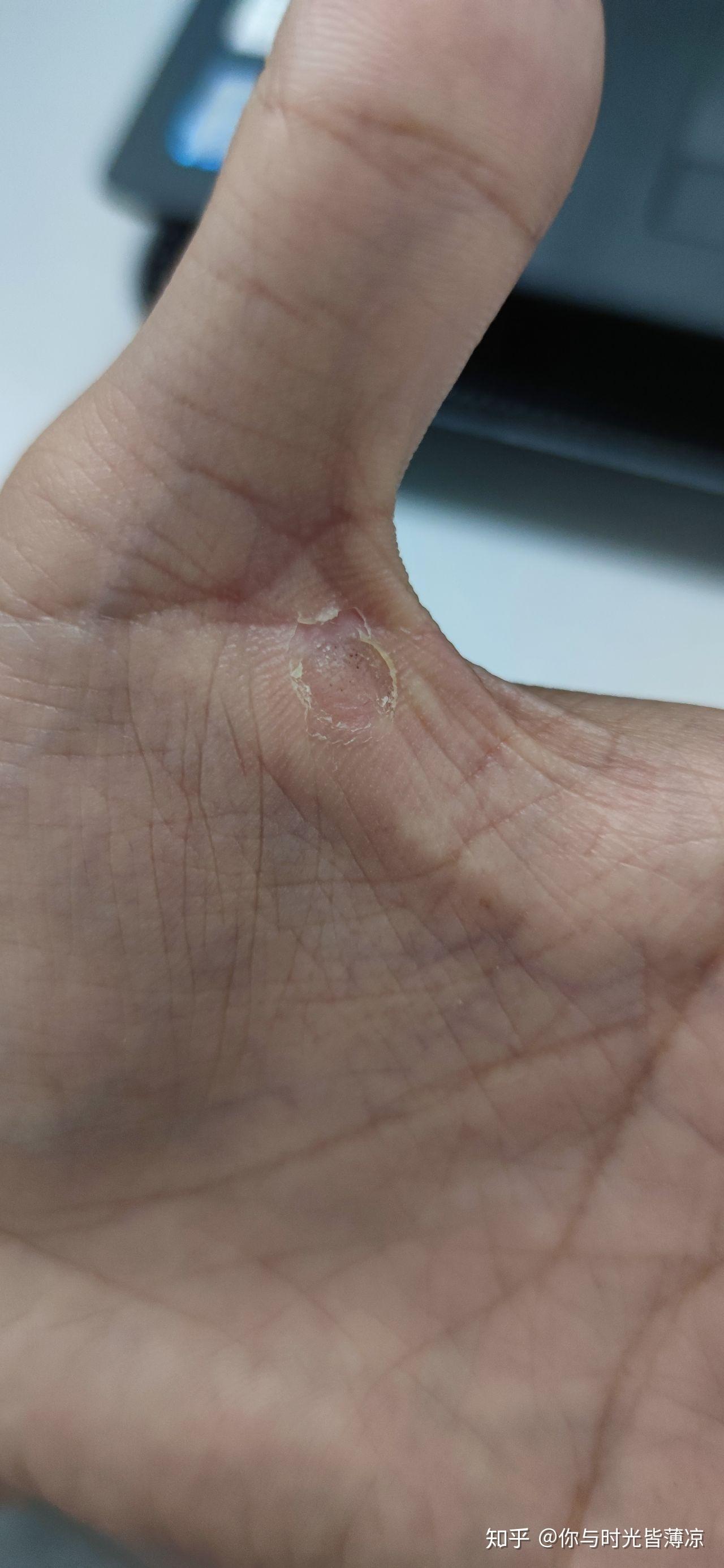 液氮冷冻治疗后手指上出了血泡而且越来越大该怎么办? 