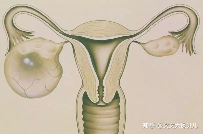 核保案例子宮內膜異位症卵巢囊腫術後重疾險標準體承保