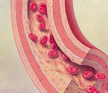 什么是动脉血管闭塞 v2-2183243a17bf809f9b3a8b695811c4ab_1440w.jpg?source=172ae18b