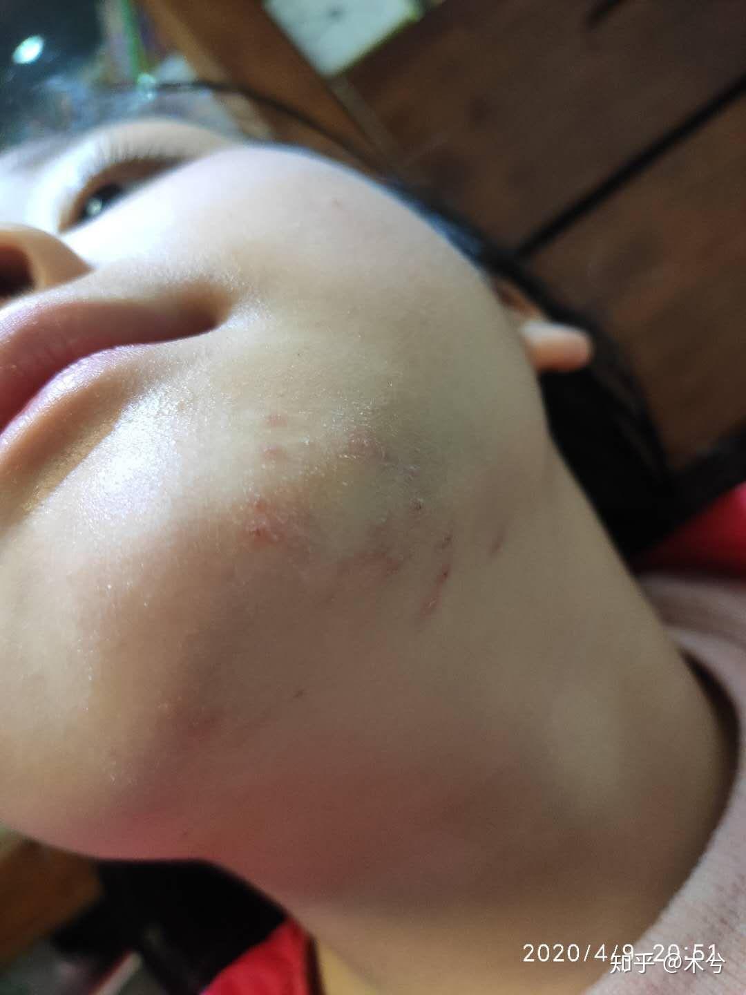 儿童下巴长传染性软疣治疗全过程图片涉及自家宝宝请勿他用谢谢