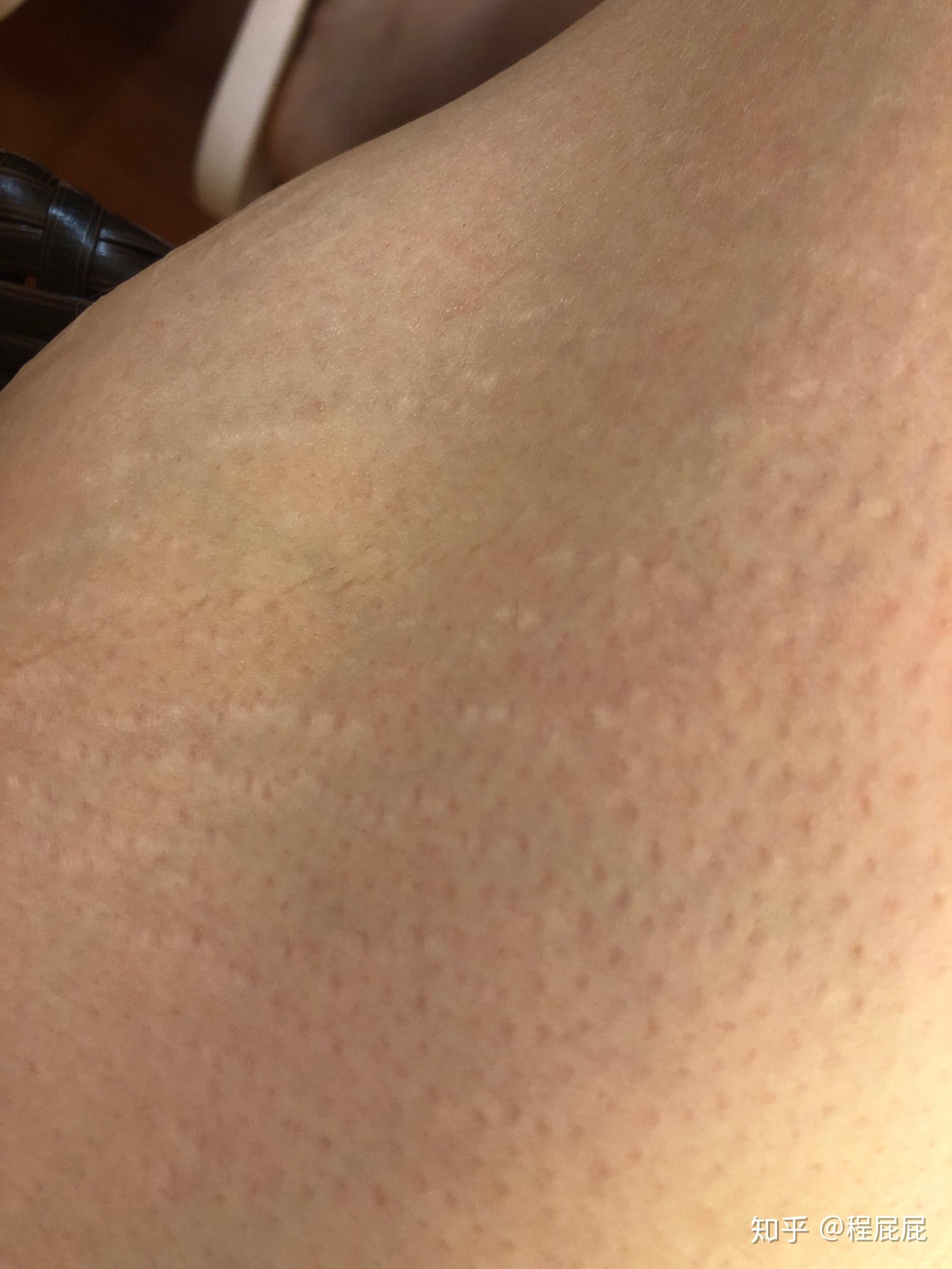 一个有鸡皮肤,鱼鳞病身上还有胖纹的女生,会有未来吗? - 知乎