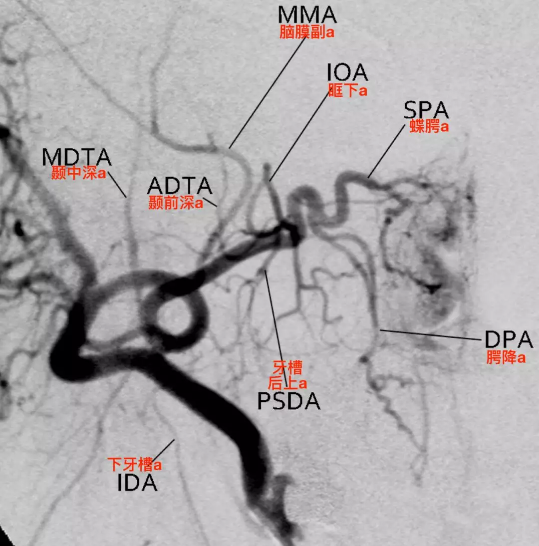 颌内动脉图片