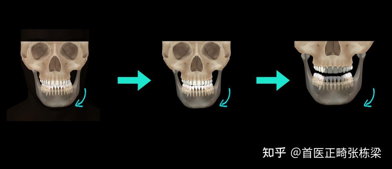 偏颌是怎样一种体验? - 知乎
