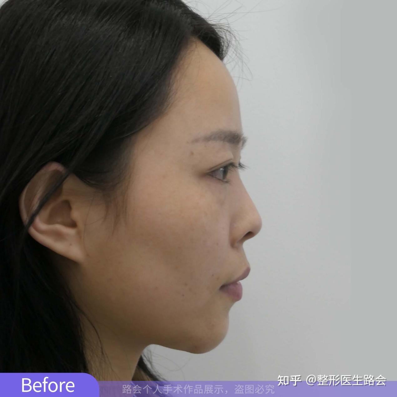 拒绝“自体骨隆鼻”,28岁姑娘独自来京整形,术后109天气质改变 - 知乎