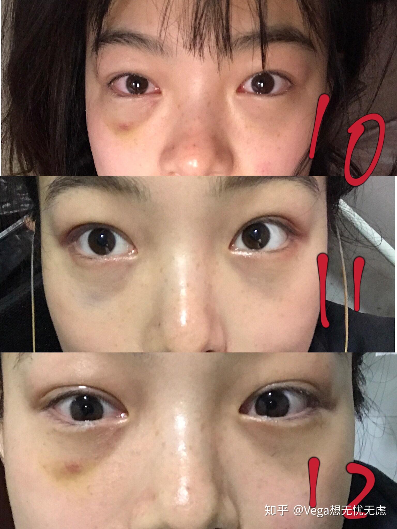 割眼袋是一种怎样的体验