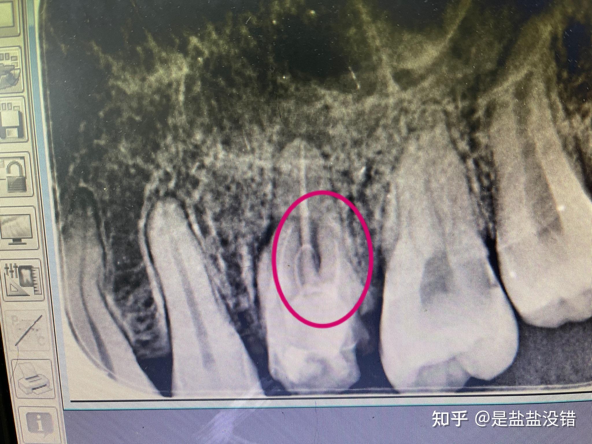 都特麼怪我年少無知,19年第一次牙痛的時候找了個私立的口腔診所看牙